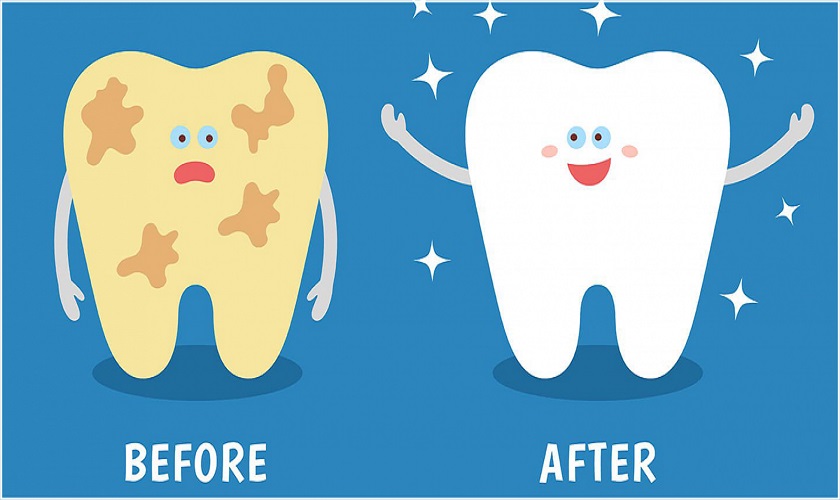 Nguyên nhân nào gây mảng bám trên răng? Loại bỏ thế nào?