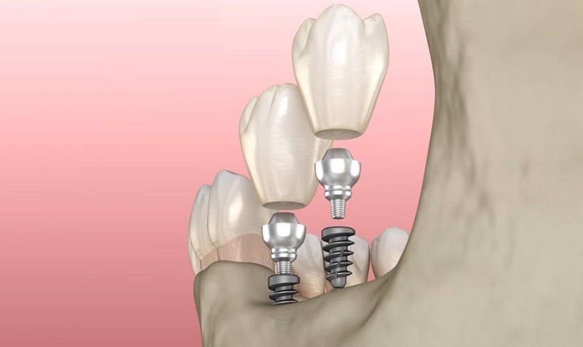 Nên cấy ghép 2 trụ Implant khi muốn phục hình 2 răng liên tiếp
