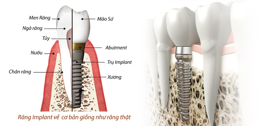 Răng Implant có cấu trúc hoàn toàn tương đồng với răng thật