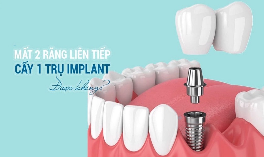 Mất 2 răng liên tiếp cấy 1 trụ Implant được không?