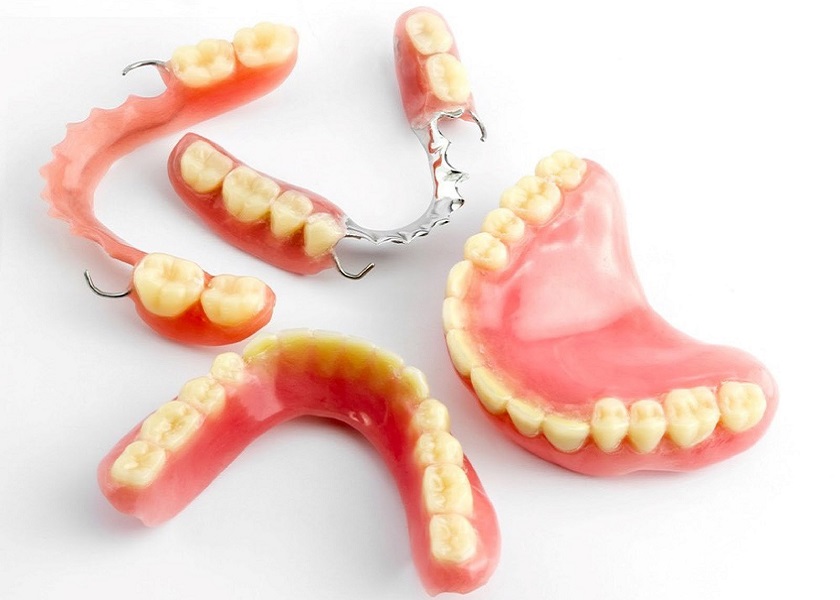 Răng giả tháo lắp là kỹ thuật trồng răng truyền thống được ứng dụng rộng rãi