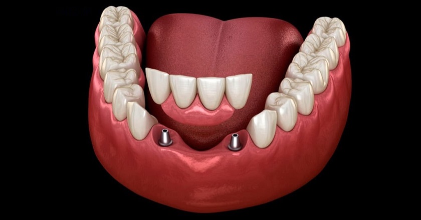 Trồng răng Implant – giải pháp tối ưu trong hầu hết các trường hợp mất răng