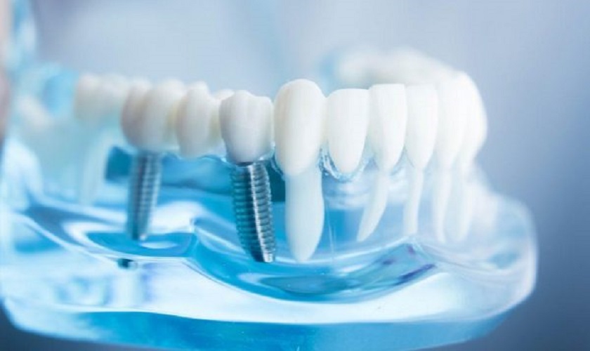 Chi phí trồng Implant khi mất 4 răng liên tiếp