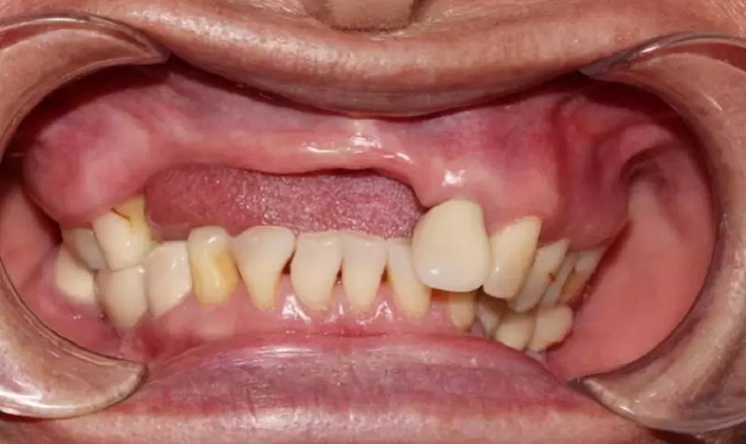 Mất 4 răng liên tiếp phục hình bằng cách nào?