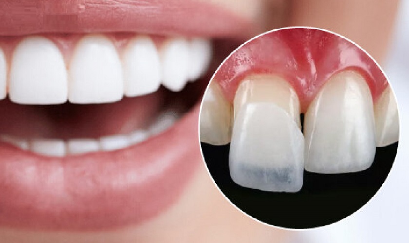 Mặt dán sứ veneer – Giải pháp thẩm mỹ răng ưu việt