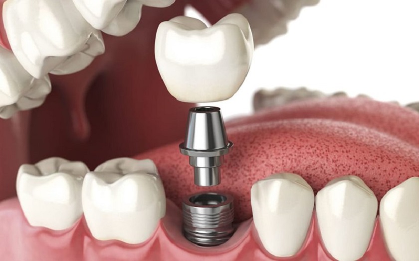 Cấy ghép răng Implant – Giải pháp tối ưu khi bị mất răng hàm