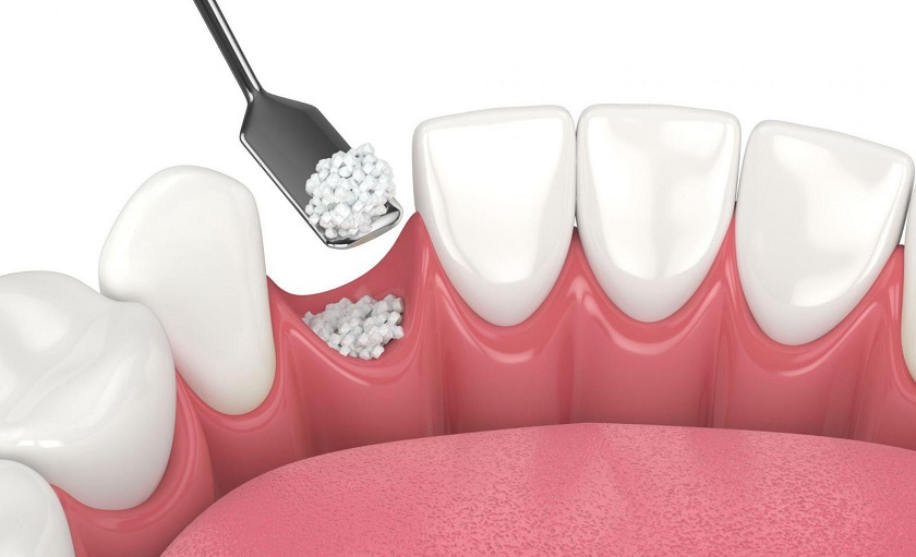 Cần ghép thêm xương trước khi cấy Implant trong một số trường hợp mất răng lâu năm