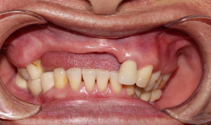Mất răng lâu năm ảnh hưởng nhiều đến việc trồng răng Implant ra sao?