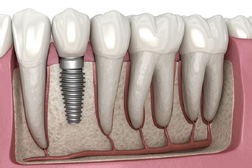 Trồng răng Implant là lựa chọn phục hình tối ưu nhất khi bị mất răng số 6