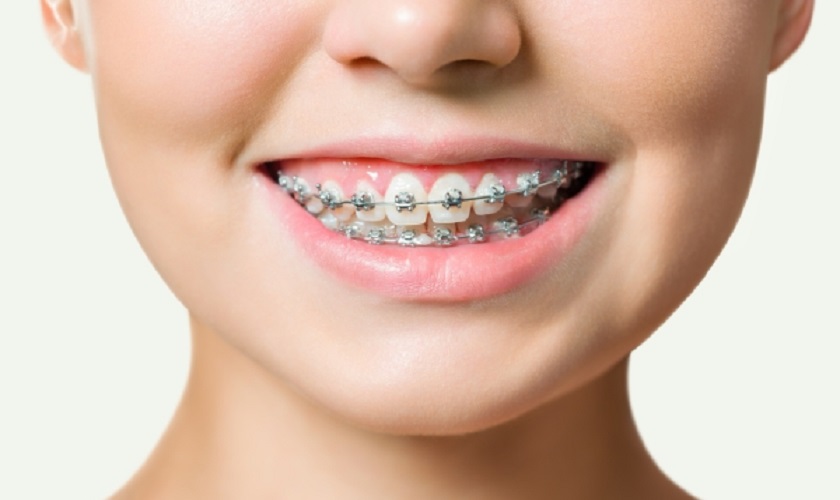 Niềng răng nếu nguyên nhân gây trề môi là do sai lệch về răng