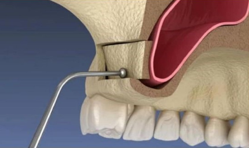 Tìm hiểu về phương pháp nâng xoang hở trong cấy ghép răng Implant