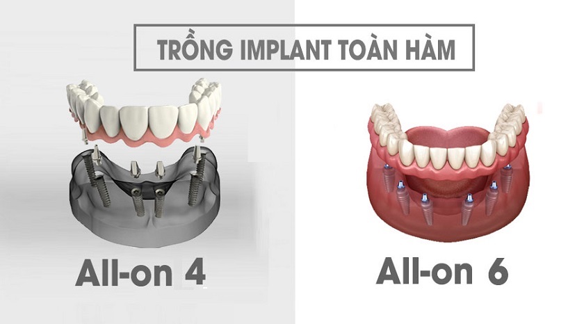 Implant All on 4 và All on 6