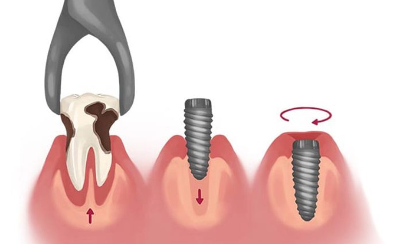 Nên trồng răng Implant ngay sau khi mất răng