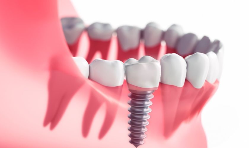 Cấy ghép Implant là giải pháp tối ưu ngăn ngừa bị mất răng hàm dưới