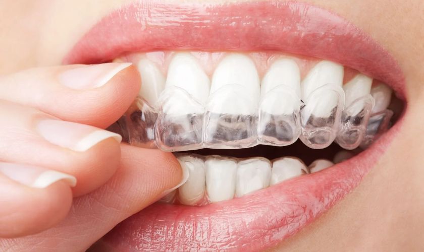 Niềng răng trong suốt Invisalign