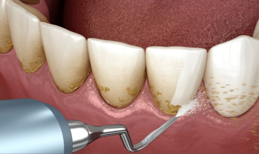 Thực hiện cao vôi răng để ngăn ngừa tình trạng sưng lợi