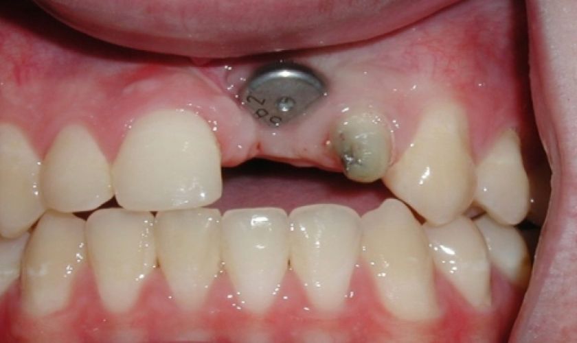 Các biến chứng có thể gặp phải sau khi cấy ghép Implant