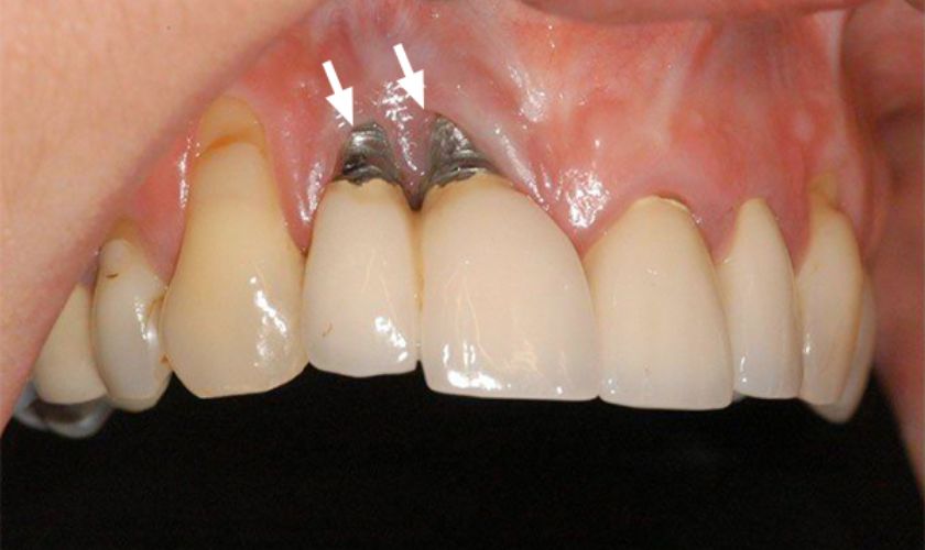 Đào thải trụ Implant xảy ra trong quá trình cấy ghép Implant sai cách