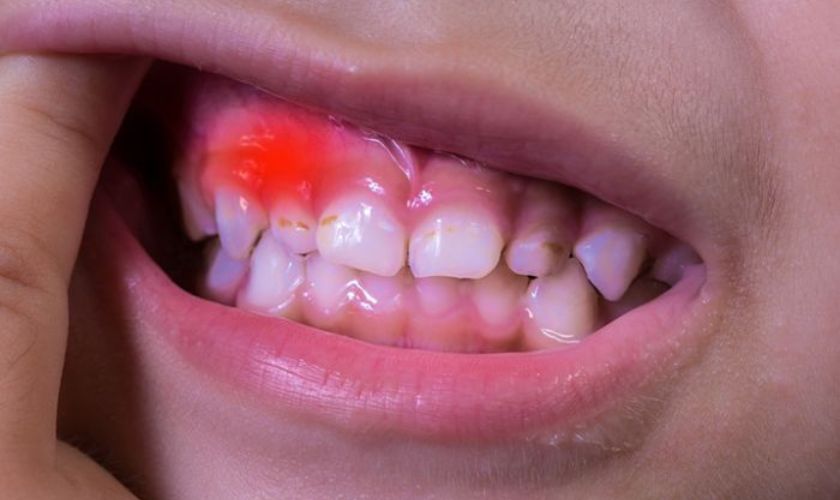 Trẻ bị viêm nướu sẽ gây đau răng