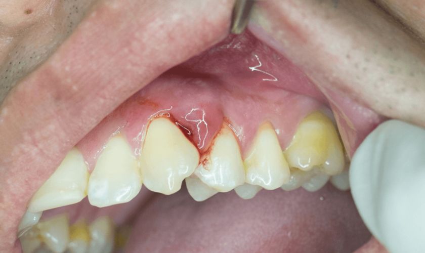 Áp xe răng sẽ gây khó chịu cho trẻ