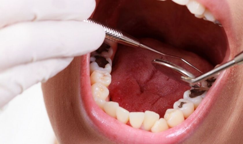 Bật mí 7 cách chữa đau răng sâu nhanh nhất tại nhà 
