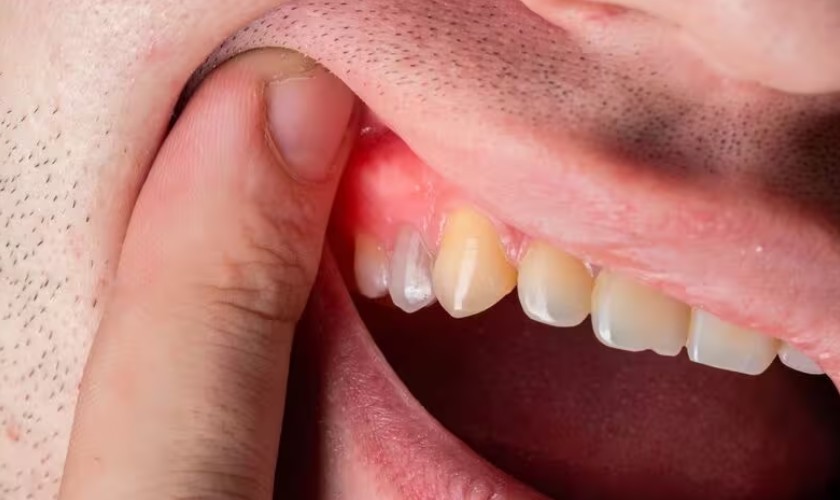 Cách chữa hết sưng lợi răng hàm tại nhà cực hiệu quả