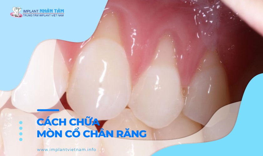 Cách chữa mòn cổ chân răng tại nhà hiệu quả