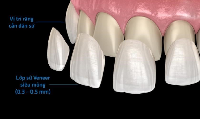 Dán sứ Veneer áp dụng trong trường hợp mòn cổ răng làm thay đổi màu sắc và hình dạng răng