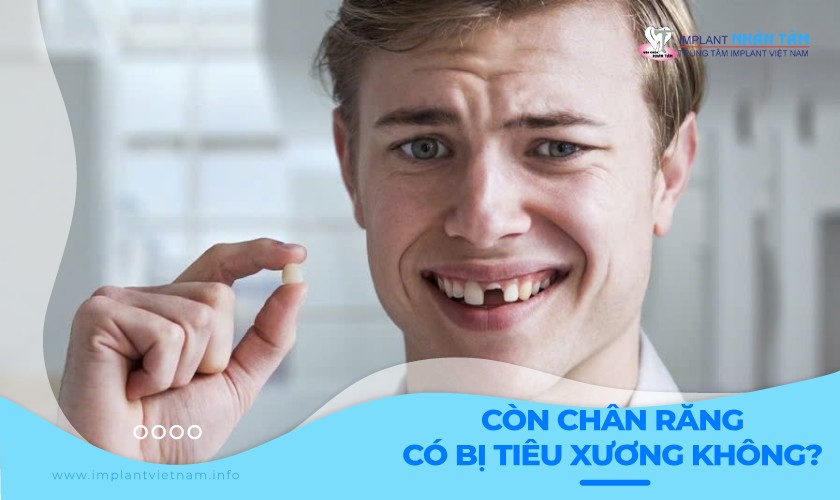 Giải đáp: Còn chân răng có bị tiêu xương không?