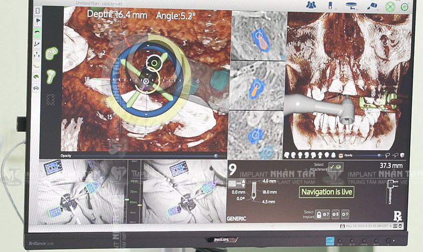 Công nghệ hiển thị rõ vị trí răng Implant cần cấy ghép Công nghệ hiển thị rõ vị trí răng Implant cần cấy ghép