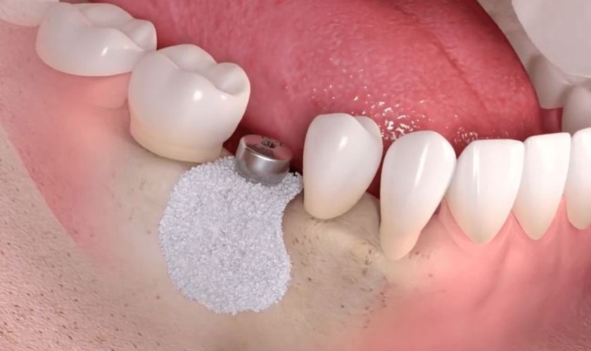 Màng PRF ứng dụng trong cấy ghép Implant