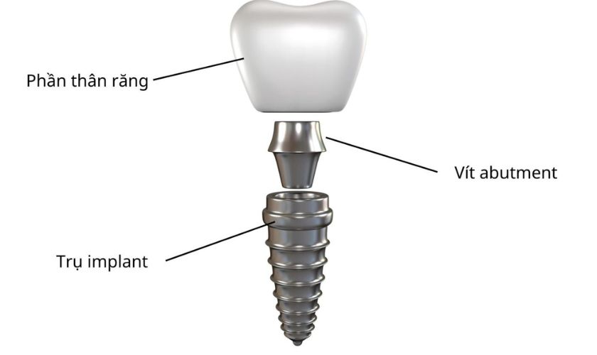 Đặc điểm của Abutmen