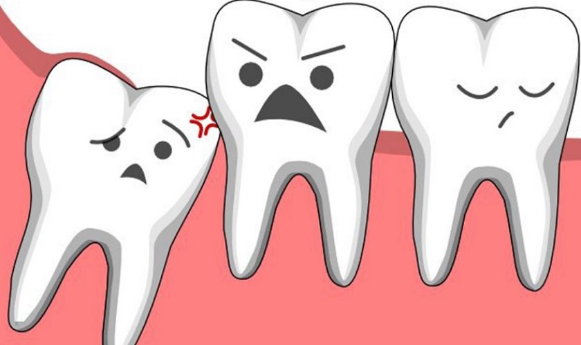 Đang đau răng khôn có nhổ được không?