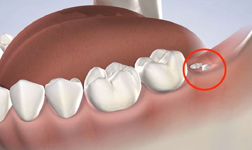 Mọc răng khôn là nguyên nhân dẫn đến tình trạng đau nhức răng