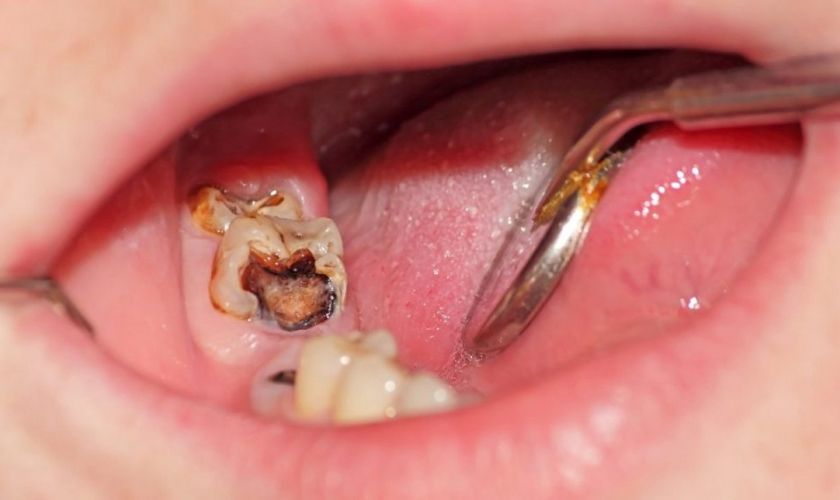 Sâu răng và viêm tủy gây nên tình trạng đau răng