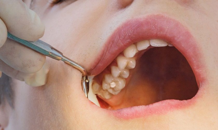Phương pháp điều trị đau răng trong cùng hàm trên