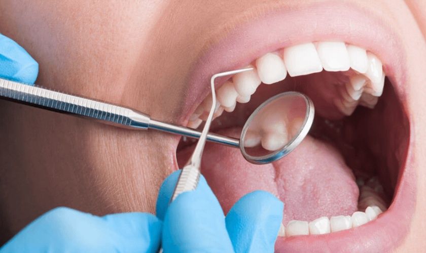 Cạo vôi răng tại Trung tâm Implant Việt Nam