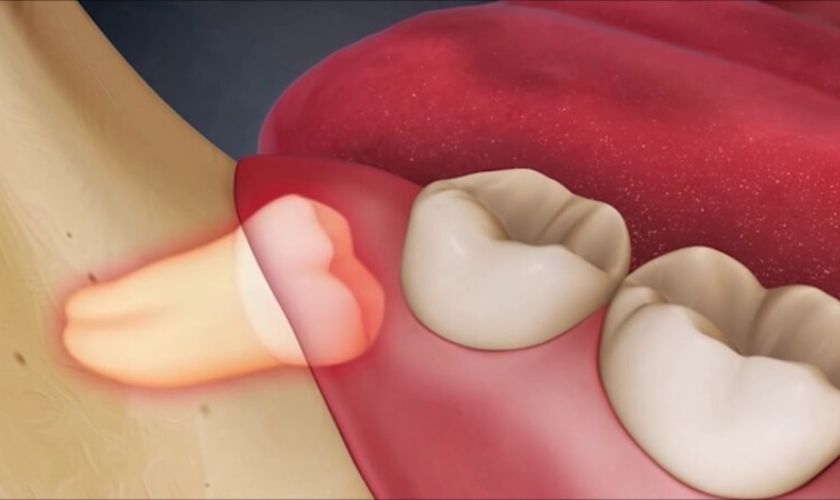 Răng khôn mọc lệch là nguyên nhân dẫn đến tình trạng đau răng