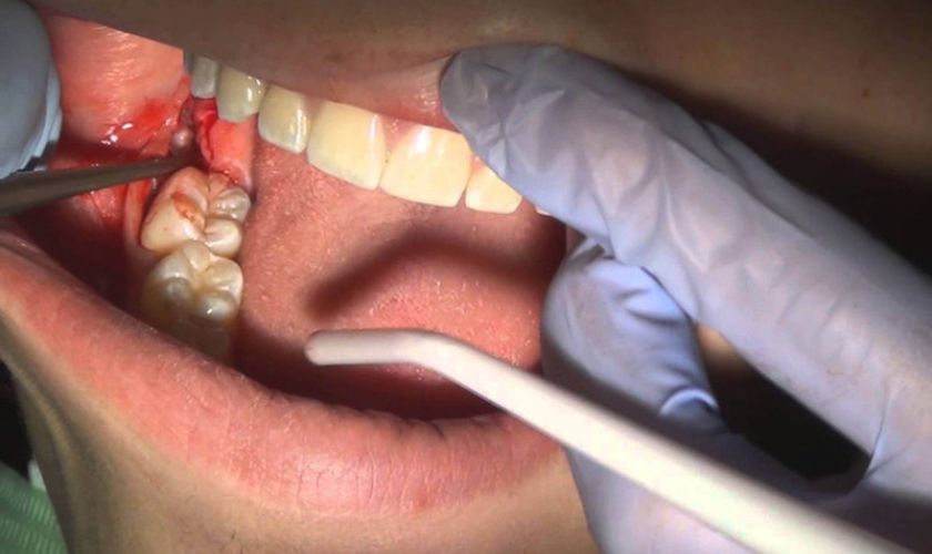 Sau khi trích rạch mủ do áp xe răng, bạn cũng có thể sử dụng thuốc giảm đau