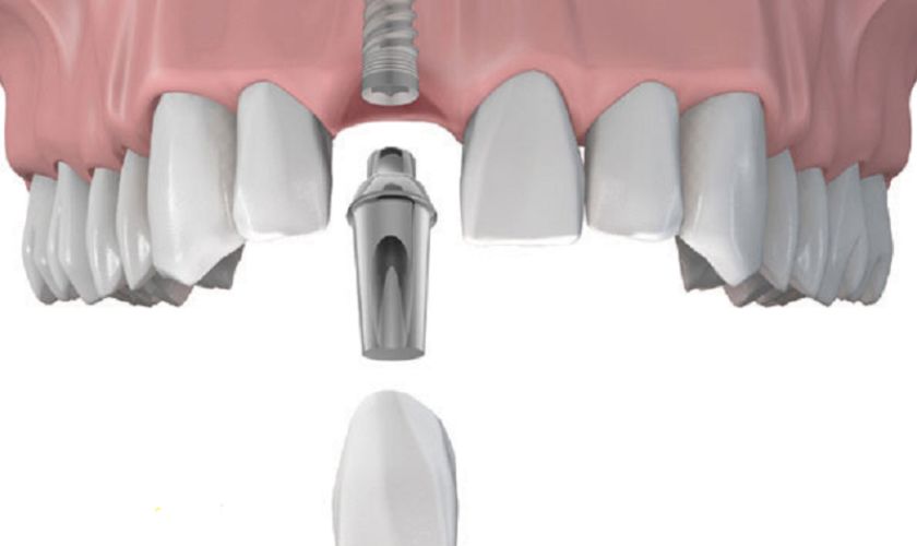 Trường hợp bệnh nhân cấy ghép Implant đơn giản không cần gây mê