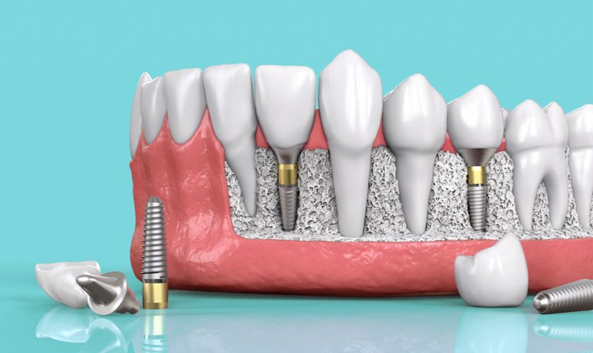 Trồng răng Implant khi phải nhổ chân răng