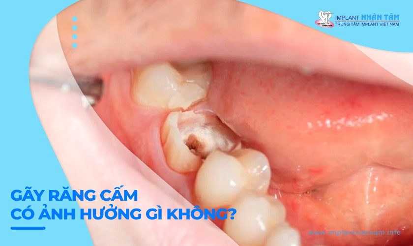 Gãy răng cấm có ảnh hưởng gì không? Cách khắc phục hiệu quả