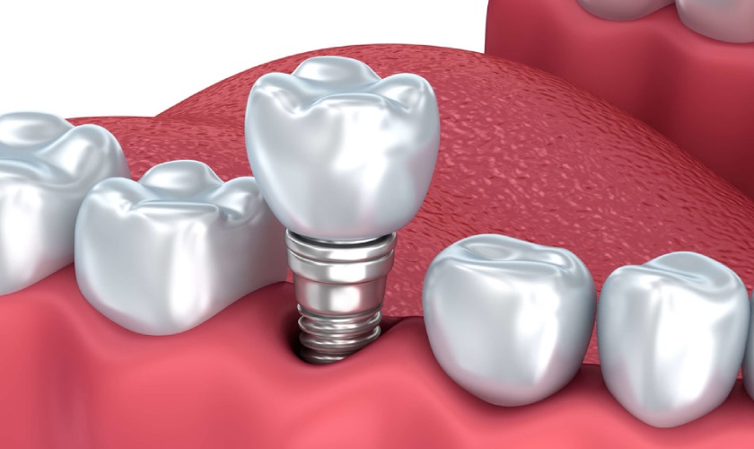 Cấy ghép implant