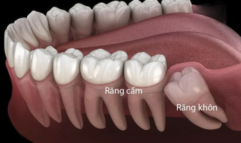 Răng cấm là gì?