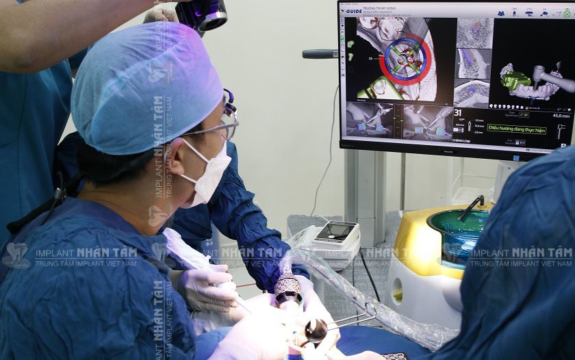Gây tê tại vùng cấy ghép phù hợp với các ca cấy ghép đơn lẻ Gây tê tại vùng cấy ghép phù hợp với các ca cấy ghép đơn lẻ