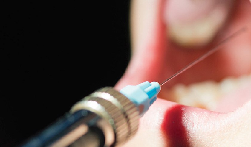 Quá trình gây tê trong cấy ghép Implant Quá trình gây tê trong cấy ghép Implant