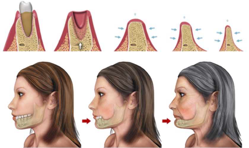 Mất răng số 6 sớm dẫn đến tình trạng hóp má