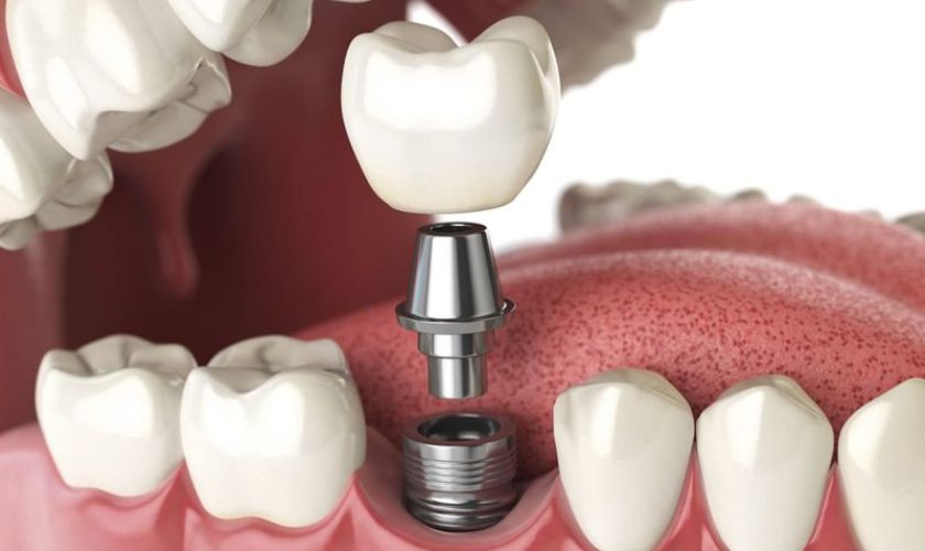 Cấy ghép Implant giúp ngăn ngừa tiêu xương do mất răng