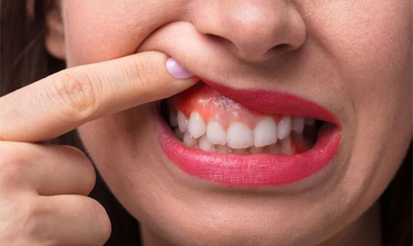 Làm sao để hết sưng chân răng hiệu quả? 
