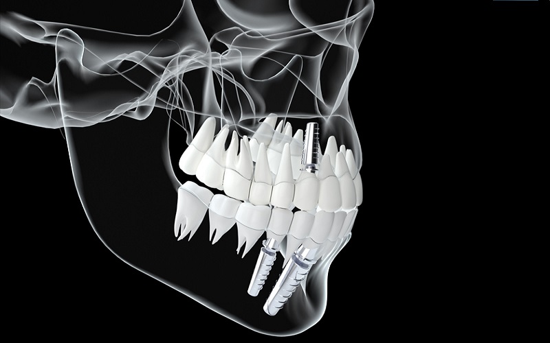 8 điều cần lưu ý trước khi cấy ghép răng Implant